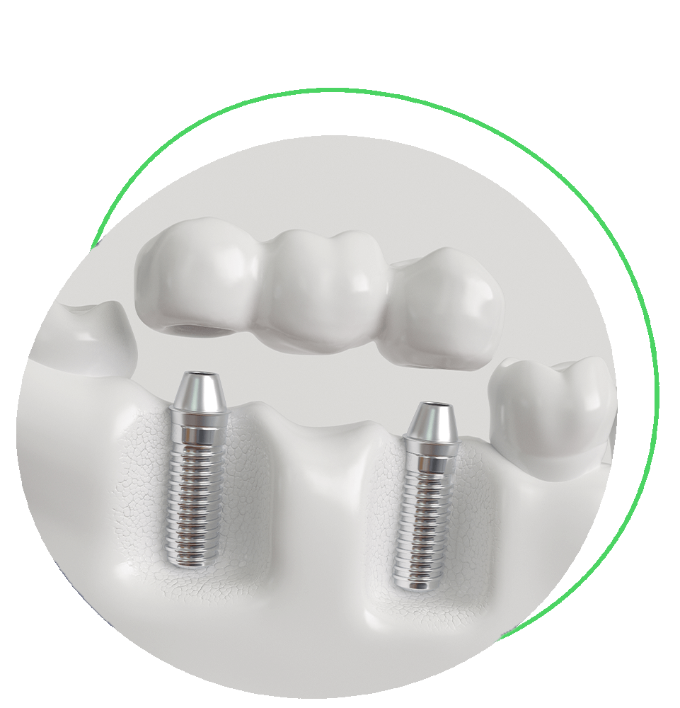 Dental Implant Options | Secure Dental