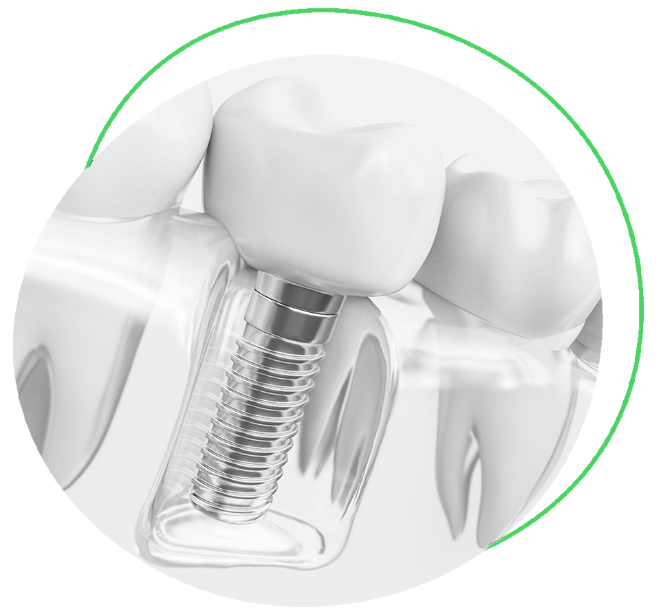 dental implants 3d rendering