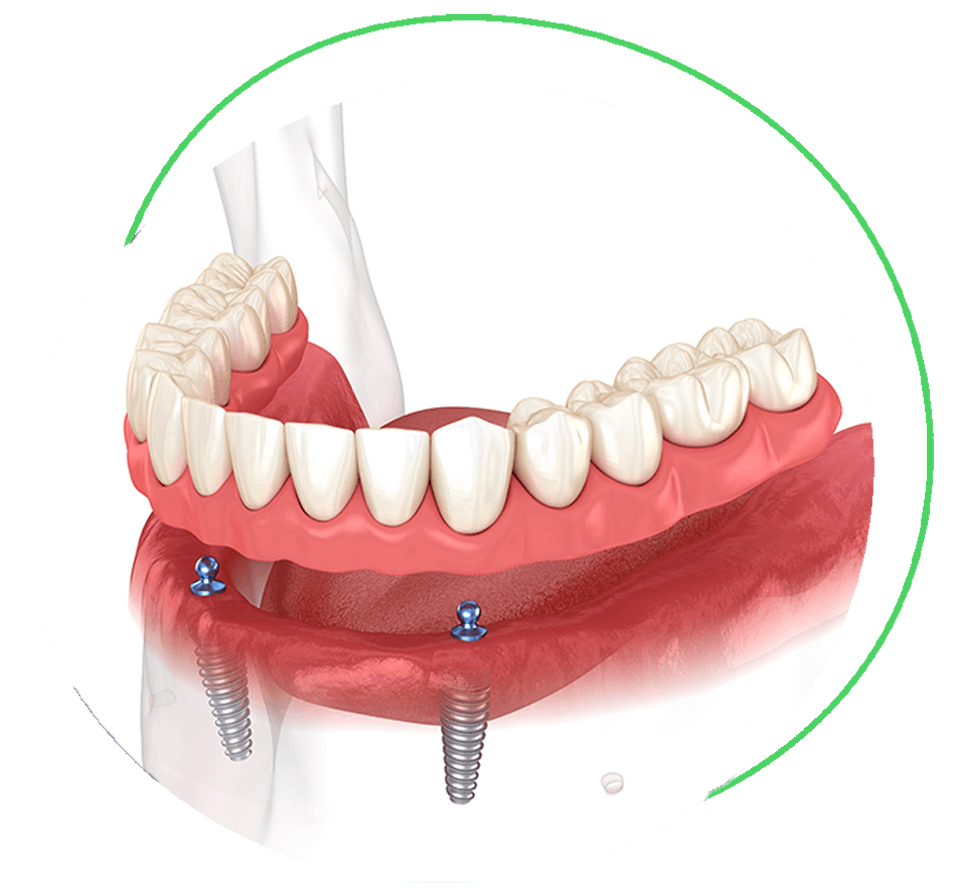 implant supported dentures