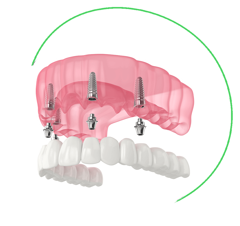 full mouth dental implants