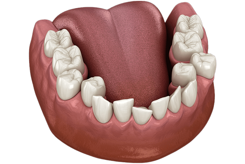 misaligned teeth from a poor diet